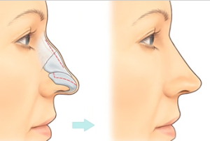nose-correction1-300x202