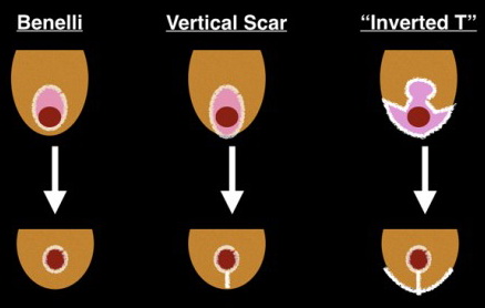 breast-lift-scar-chart-560x404
