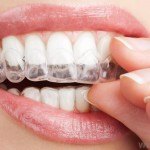 tooth-whitening-tray